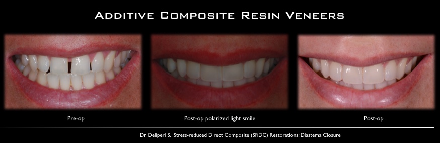 additive composite resin veneers
