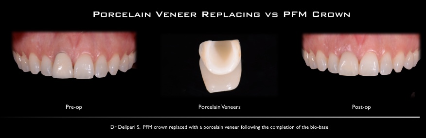 porcelan veneers replacing vs PFM crown